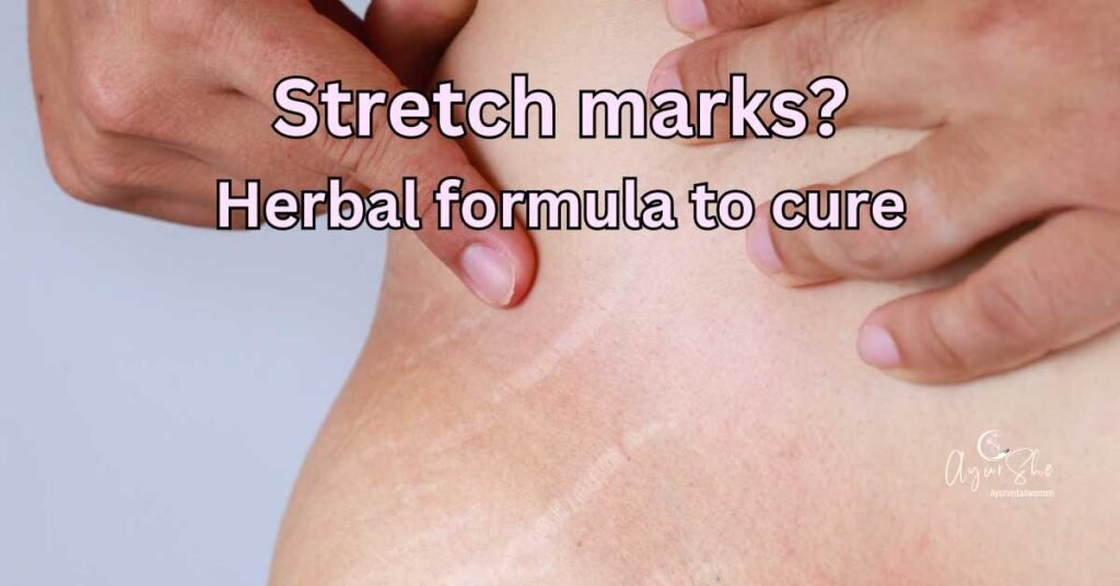 stretch marks